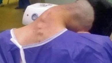 ایران میں ڈاکٹروں نے منشیات کے استعمال سے پیدا ہونے والی نایاب طبی حالت کا انکشاف کر دیا