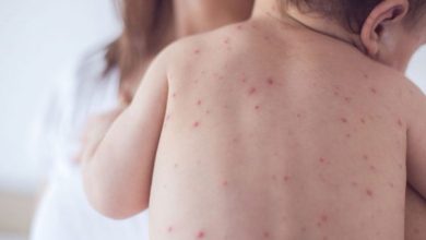 امریکا میں خسرہ کے کیسز میں 25 سال بعد تشویشناک اضافہ ٹیکساس میں سب سے زیادہ متاثرہ علاقے کے طور پر سامنے آیا