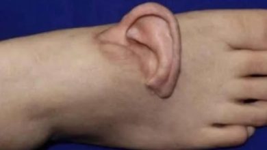 پاؤں سے جڑا کان: چینی ڈاکٹروں نے منفرد اور کامیاب سرجری سے خاتون کی سماعت بحال کردی