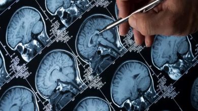 تحقیق: الزائمرز اور ڈیمینشیا کے لیے APOE جین لازمی